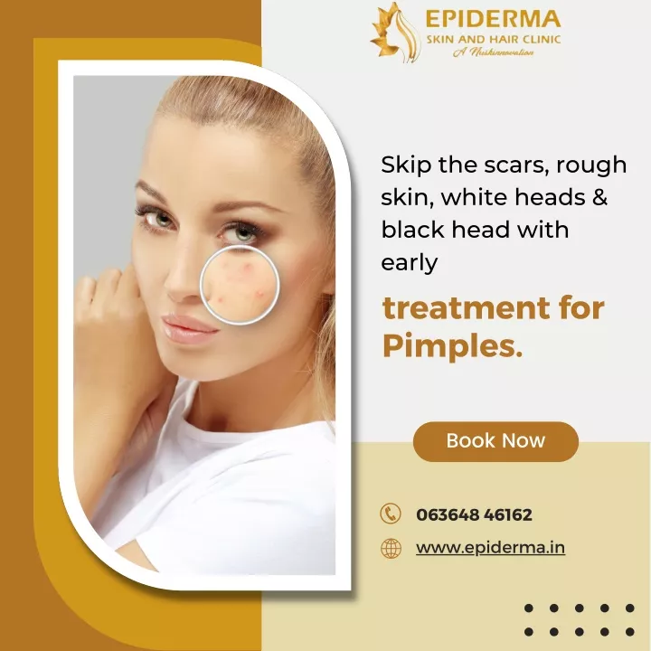 PPT Get The Advanced Treatment For Pimples Epiderma Skin Clinic In