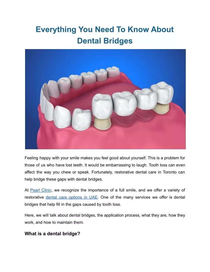 everything you need to know about dental bridges