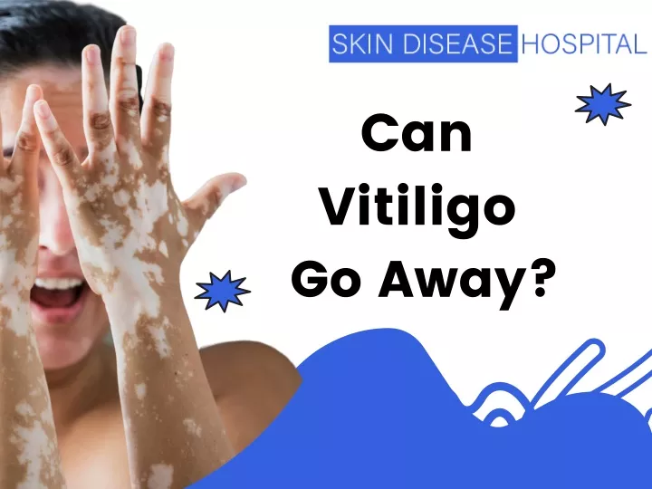 can vitiligo go away