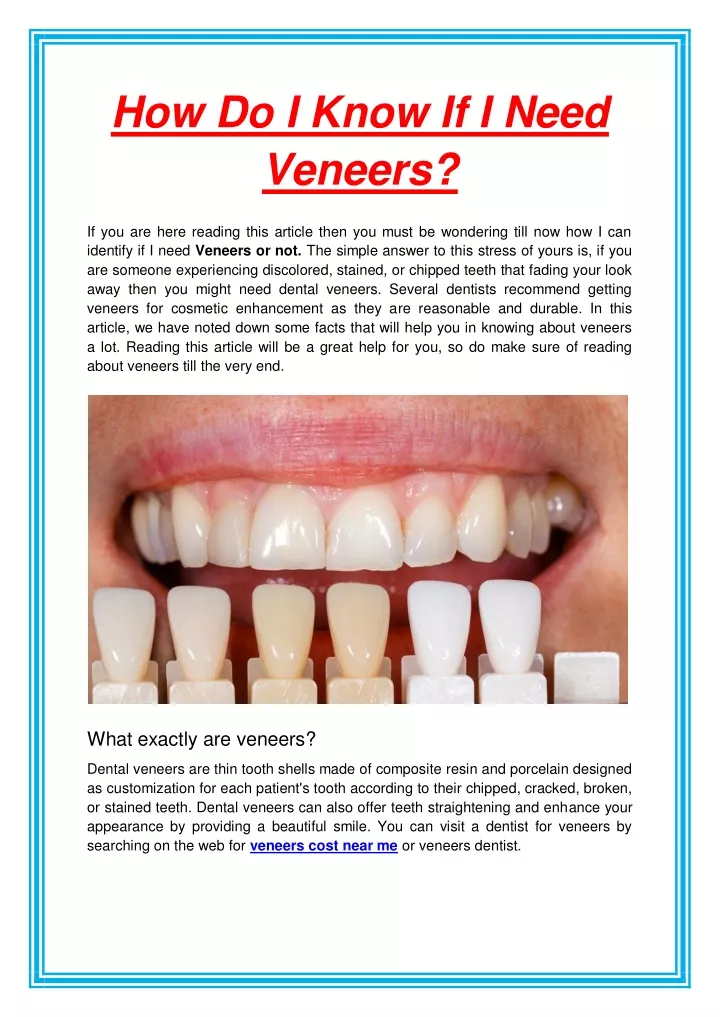 how do i know if i need veneers