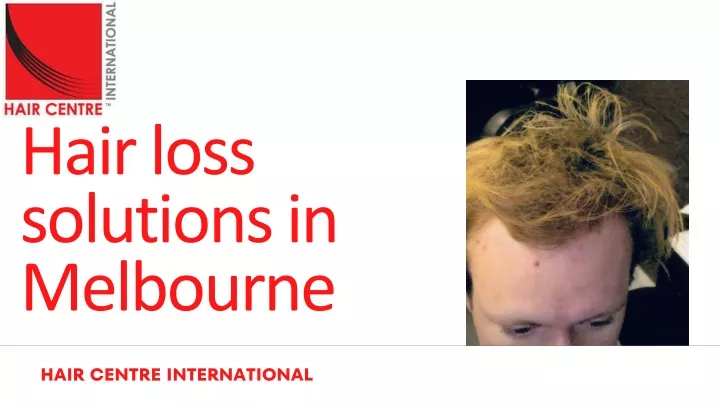 hair loss solutions in melbourne