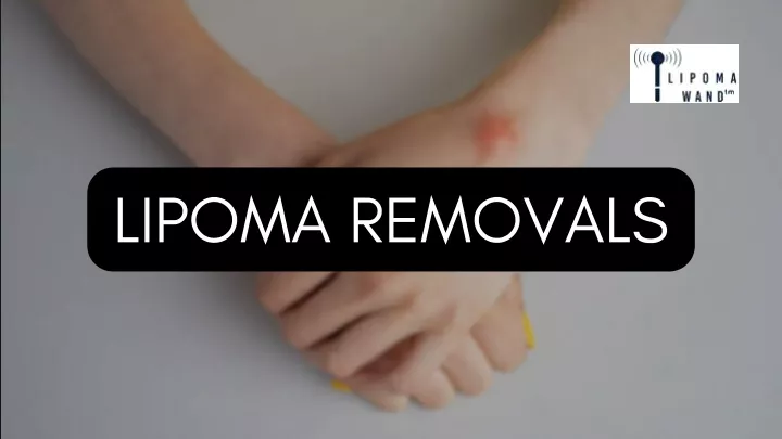 lipoma removals