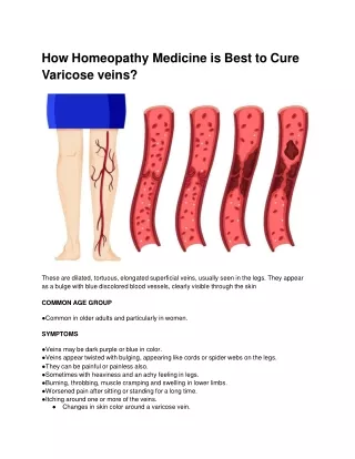 How Homeopathy Medicine is Best to Cure Varicose veins?