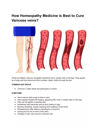 How Homeopathy Medicine is Best to Cure Varicose veins?