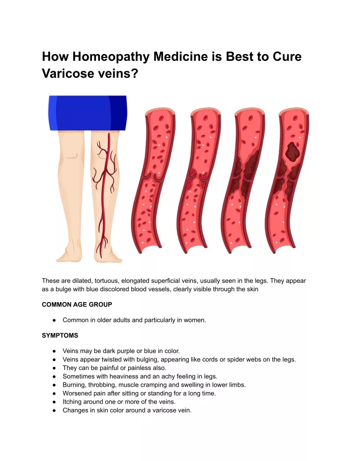 how homeopathy medicine is best to cure varicose