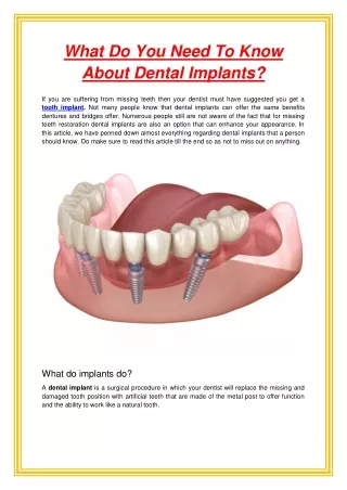 what do you need to know about dental implants