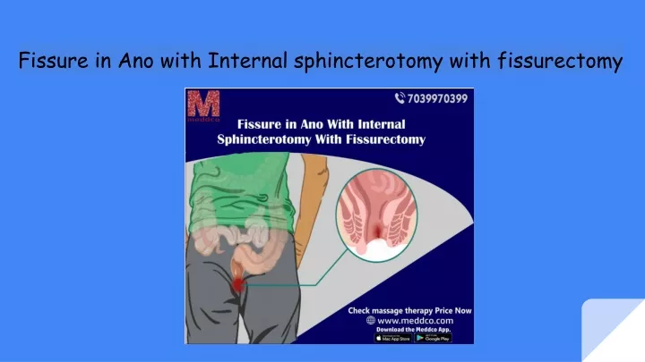 fissure in ano with internal sphincterotomy with fissurectomy