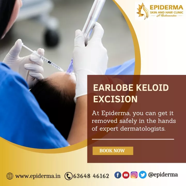 earlobe keloid excision