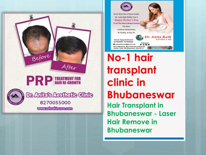 no 1 hair transplant clinic in bhubaneswar