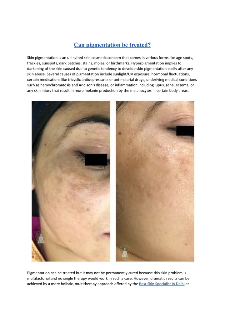 can pigmentation be treated