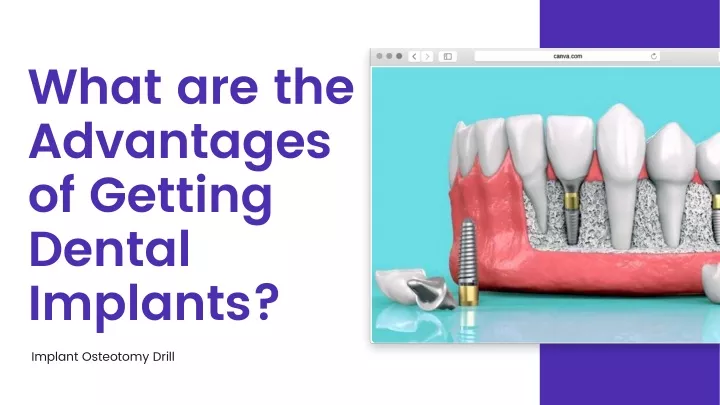 what are the advantages of getting dental