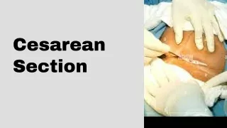 Cesarean Section Anesthesia Implications