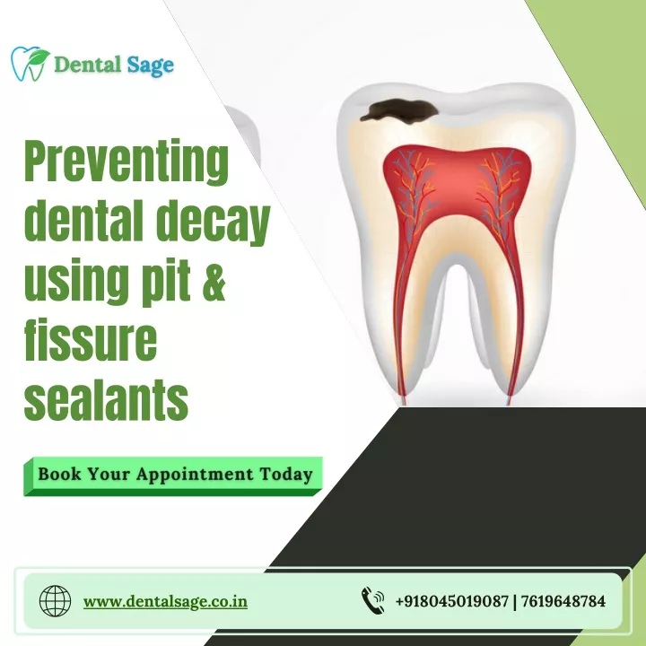 preventing dental decay using pit fissure sealants