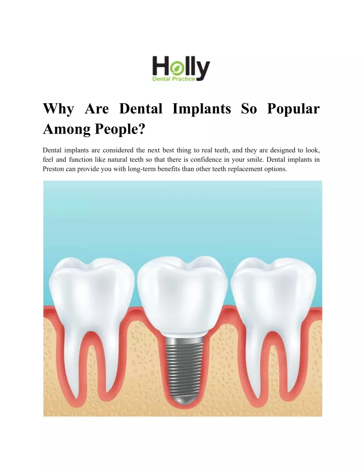 why are dental implants so popular among people