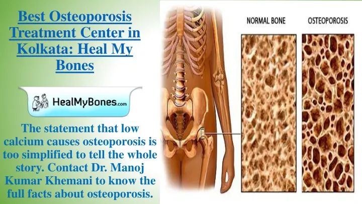 best osteoporosis treatment center in kolkata heal my bones