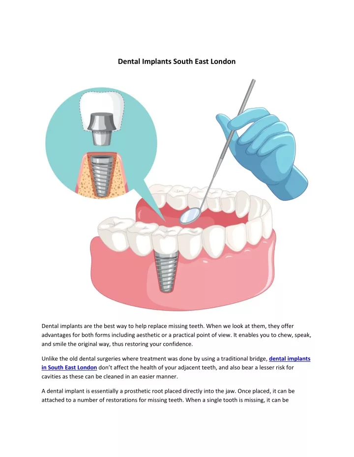 dental implants south east london