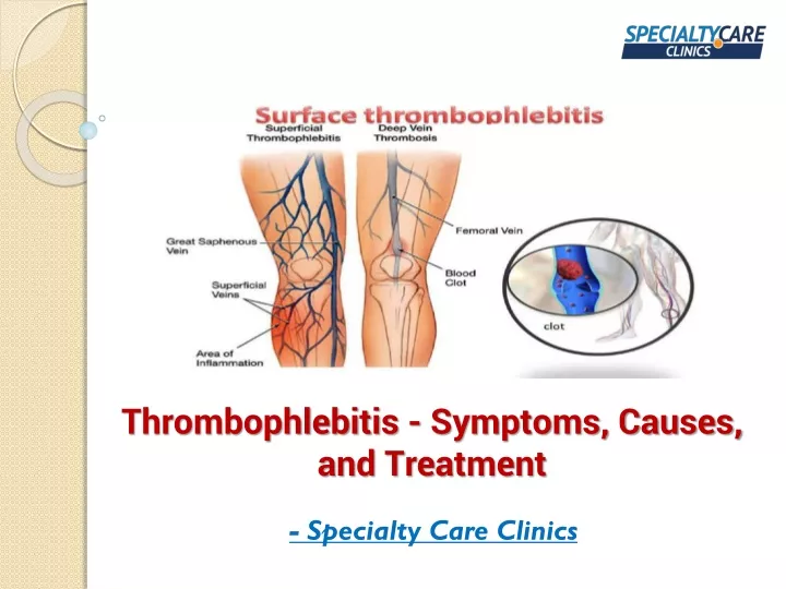 thrombophlebitis symptoms causes and treatment