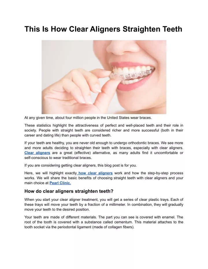 this is how clear aligners straighten teeth