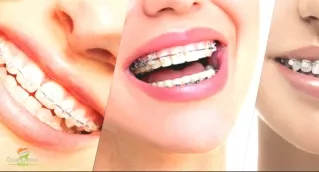 CosmodentIndia For Teeth Braces in India