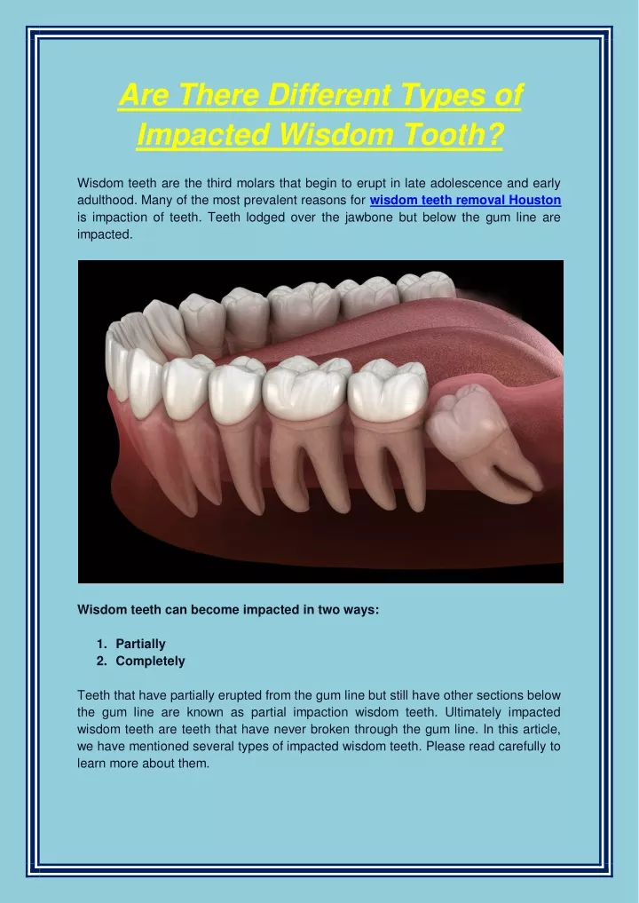 are there different types of impacted wisdom tooth