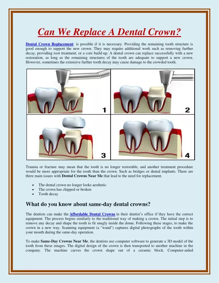 can we replace a dental crown