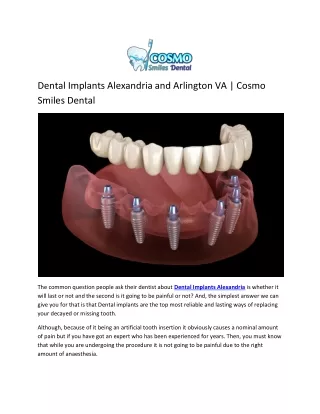 Dental Implants Alexandria and Arlington VA | Cosmo Smiles Dental