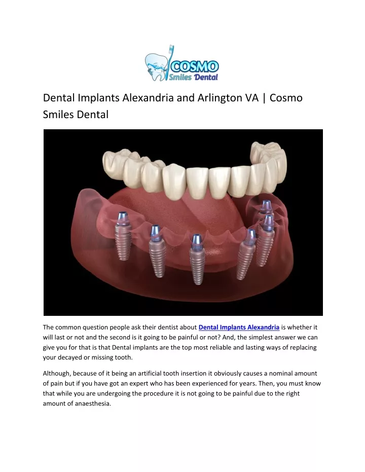 dental implants alexandria and arlington va cosmo