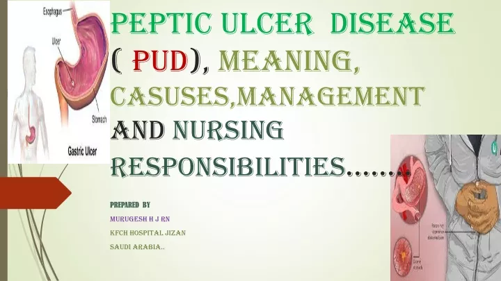 peptic ulcer disease pud meaning casuses management and nursing responsibilities