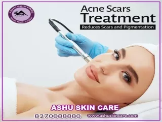india's Best acne scar treatment clinic  in bhubaneswar, odisha