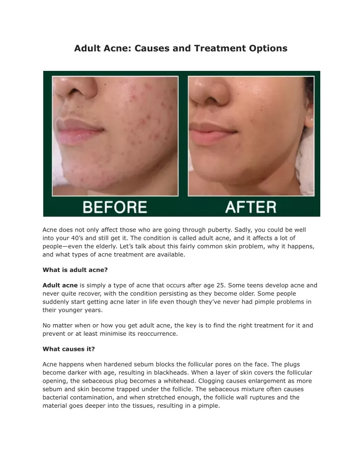 adult acne causes and treatment options