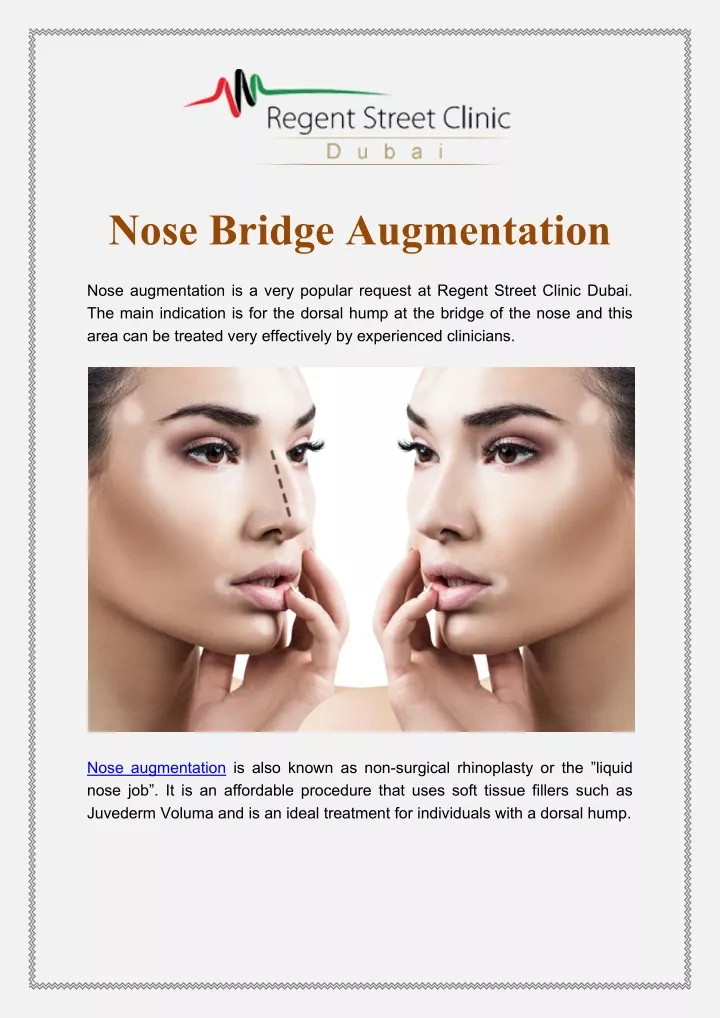 nose bridge augmentation