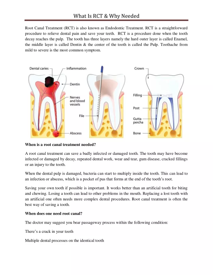 what is rct why needed