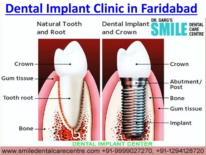 dental implant clinic in faridabad