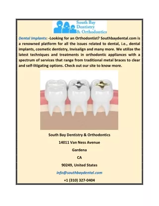 Dental Implants | Southbaydental.com