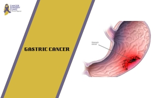 Surgeon Doctor For Gastric Cancer Treatment