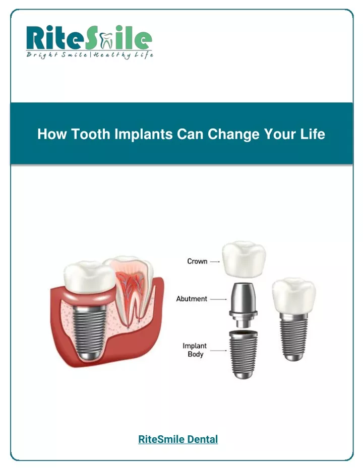 how tooth implants can change your life