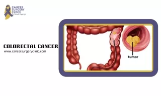 Colorectal Cancer Treatment By Dr Ganesh Nagarajan