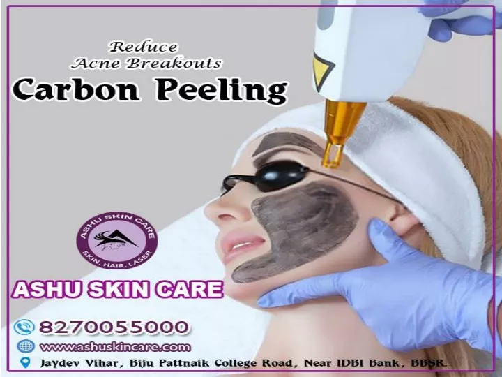 PPT ashu skin care is one of the best carbon laser peeling treatment