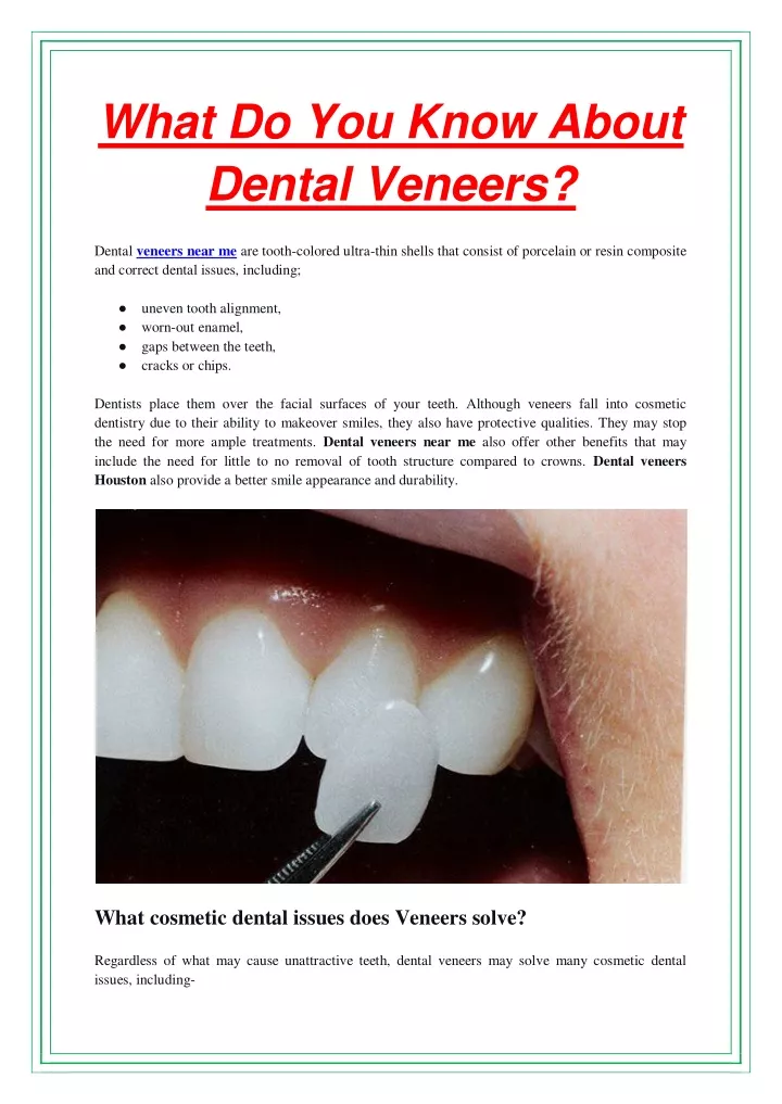 what do you know about dental veneers