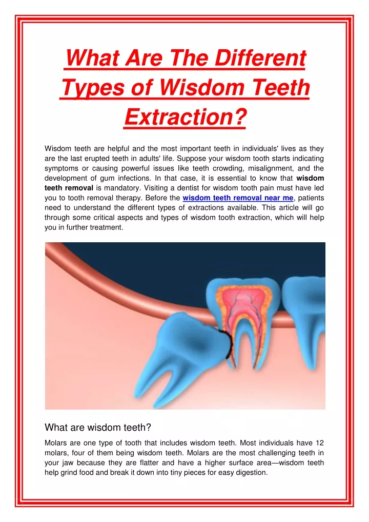 what are the different types of wisdom teeth