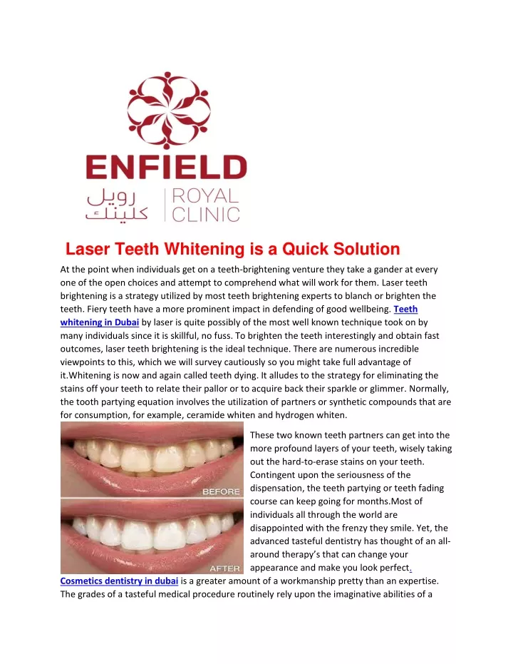 laser teeth whitening is a quick solution