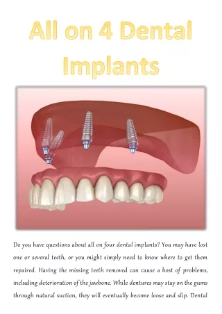 do you have questions about all on four dental