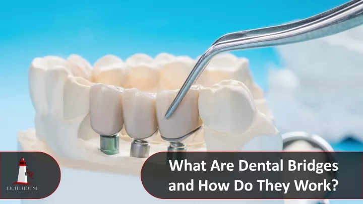 what are dental bridges and how do they work