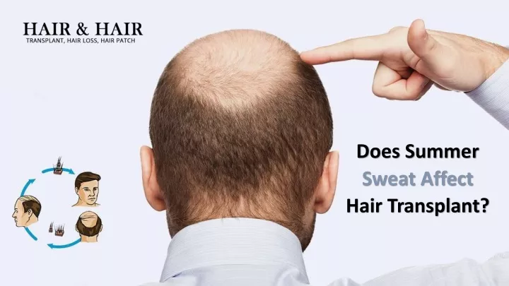 does summer sweat affect hair transplant