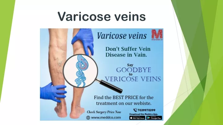 varicose veins