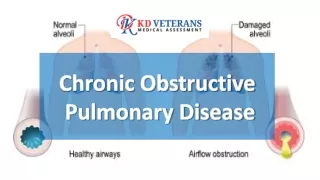 Chronic Obstructive   Pulmonary Disease