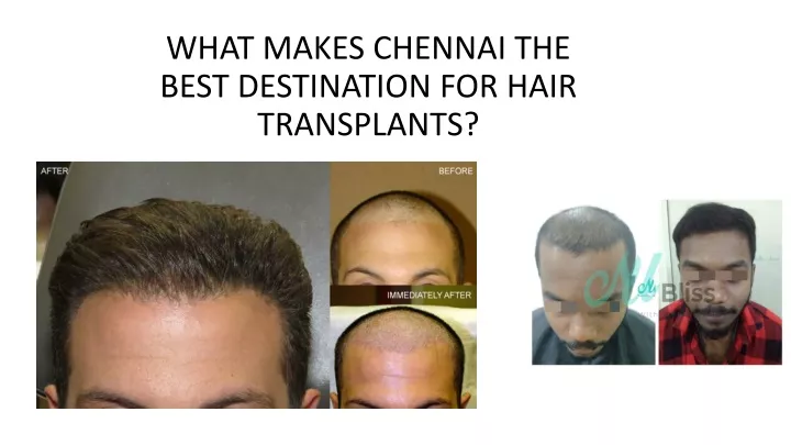 what makes chennai the best destination for hair transplants