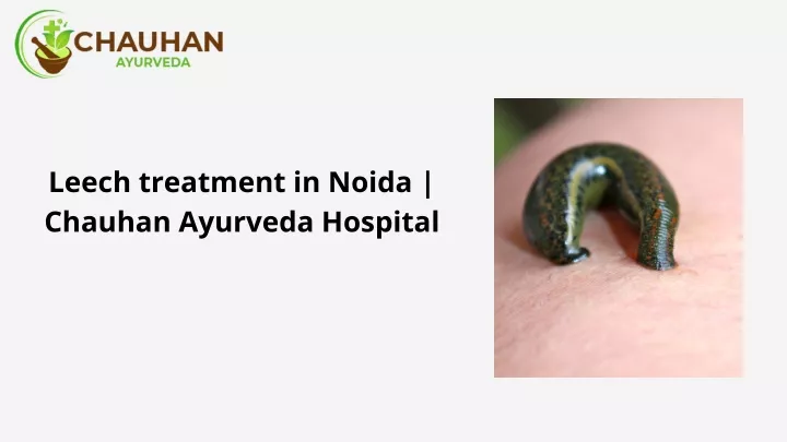 leech treatment in noida chauhan ayurveda hospital