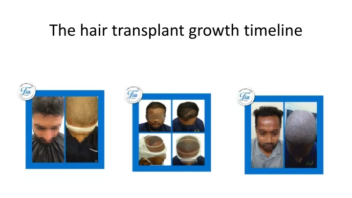 the hair transplant growth timeline