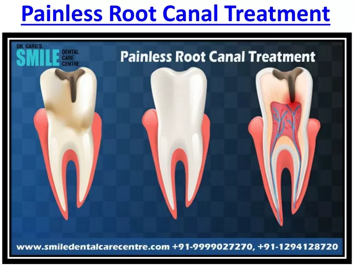 painless root canal treatment